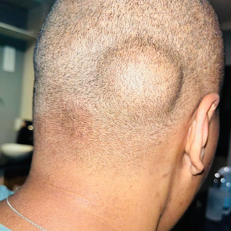 A large lipoma (benign fatty lump) on the back of a patient's head, behind the ear
