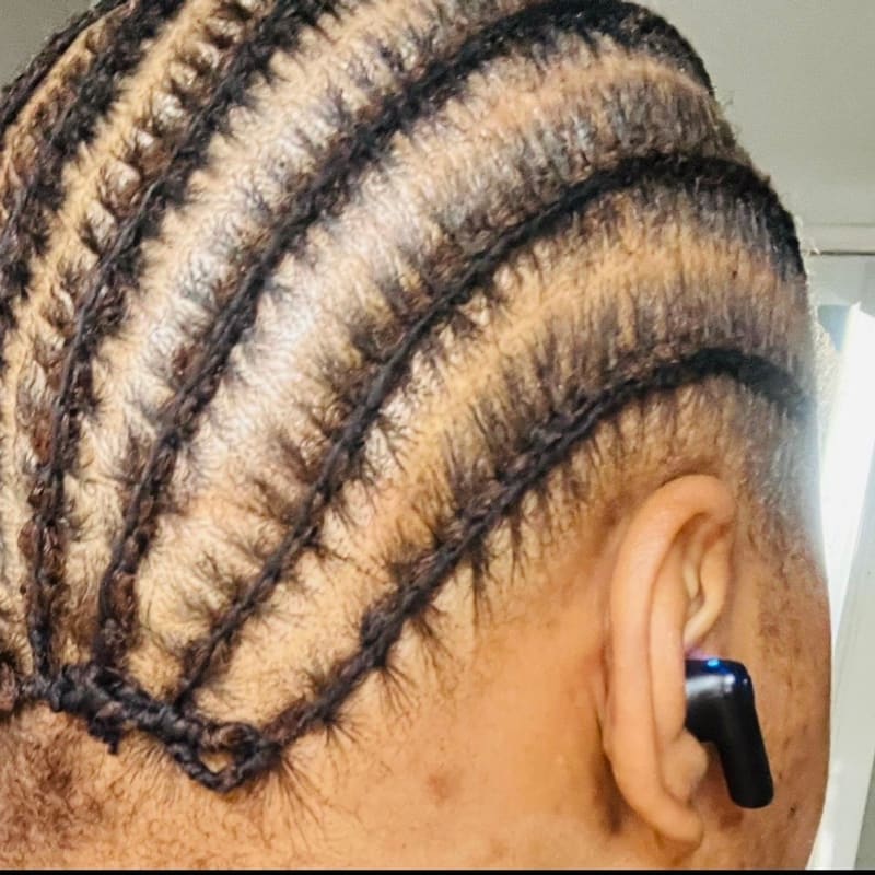 The same patient once healed, with her hair grown back and braided over the scar