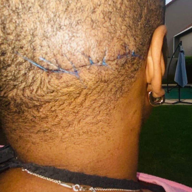 The same area after the lipoma was removed, closed with a neat line of stitches