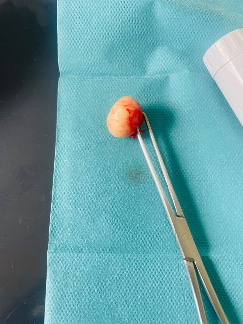 The same cyst after removal, held in surgical forceps