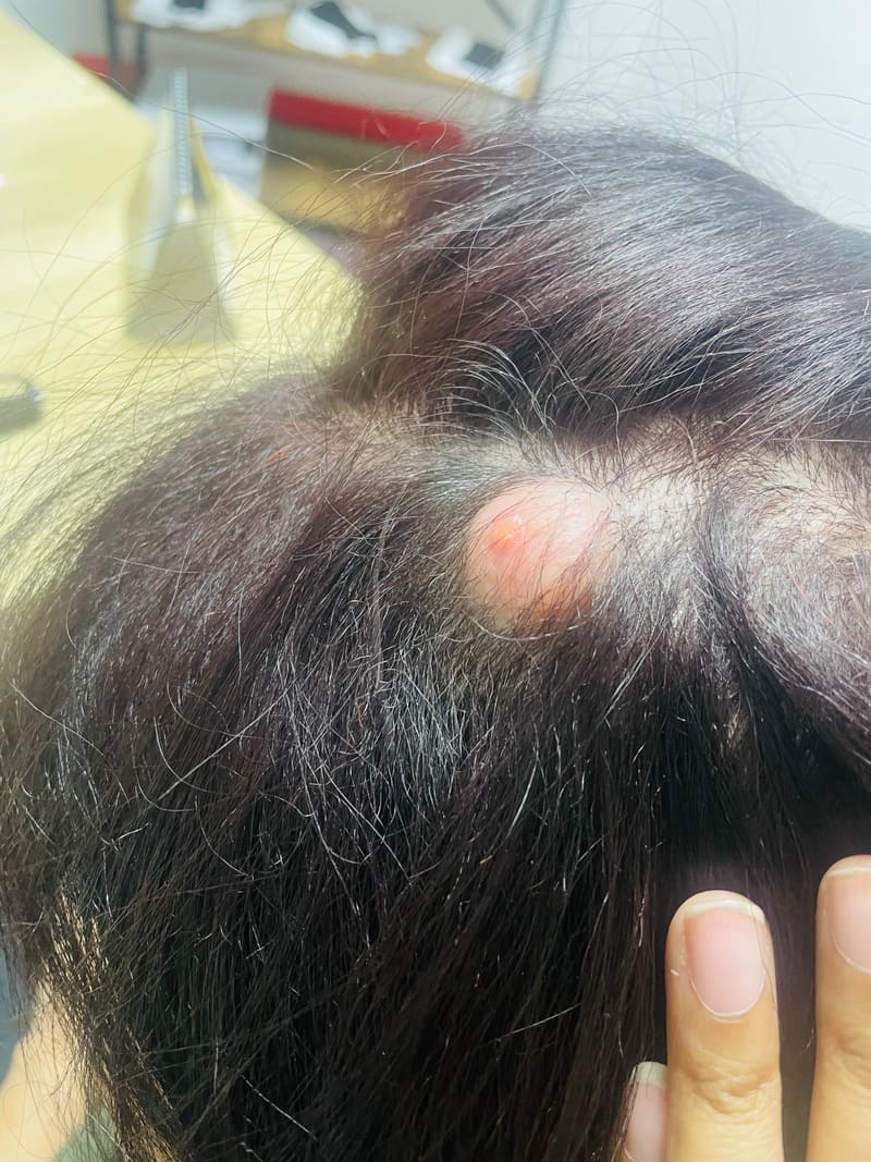 A raised, round cyst on a patient's scalp before removal